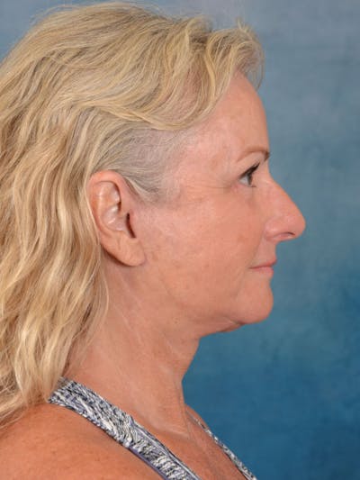 Deep Plane Facelift Before & After Gallery - Patient 158443135 - Image 6
