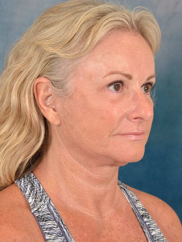 Deep Plane Facelift Before & After Gallery - Patient 158443135 - Image 8