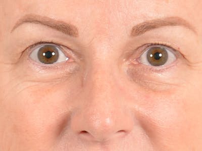 Eyelid Lift Before & After Gallery - Patient 158443150 - Image 1