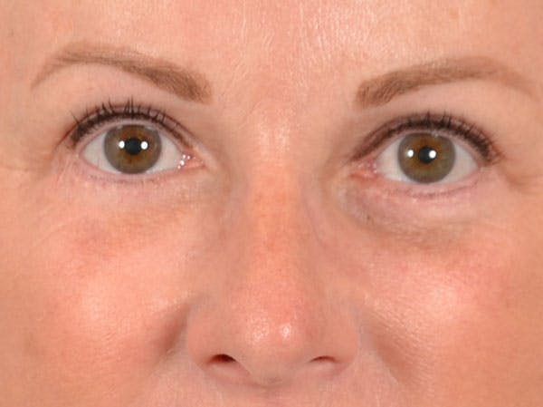 Eyelid Lift Before & After Gallery - Patient 158443150 - Image 2