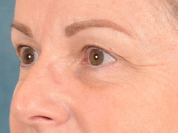 Eyelid Lift Before & After Gallery - Patient 158443150 - Image 3