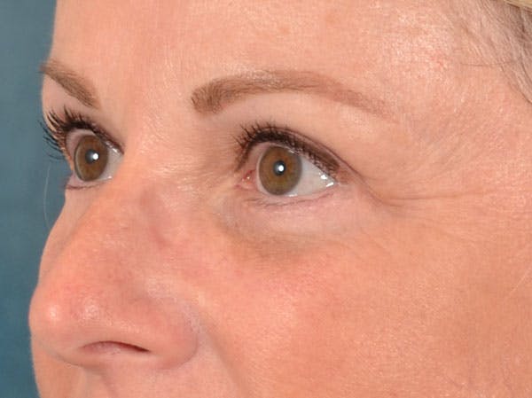 Eyelid Lift Before & After Gallery - Patient 158443150 - Image 4
