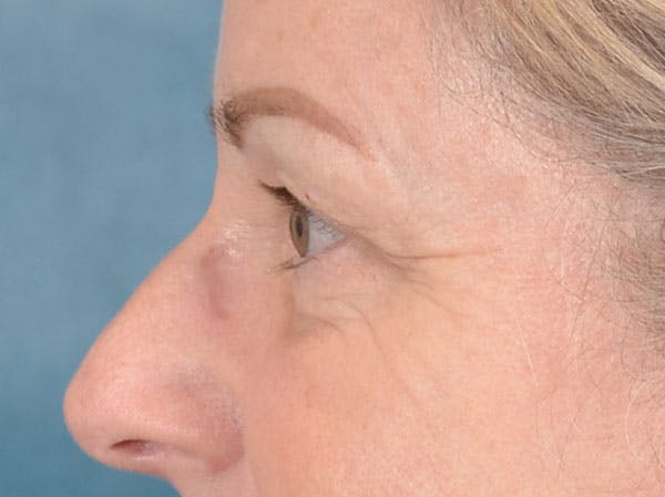 Eyelid Lift Before & After Gallery - Patient 158443150 - Image 5