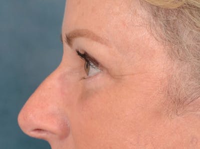 Eyelid Lift Before & After Gallery - Patient 158443150 - Image 6