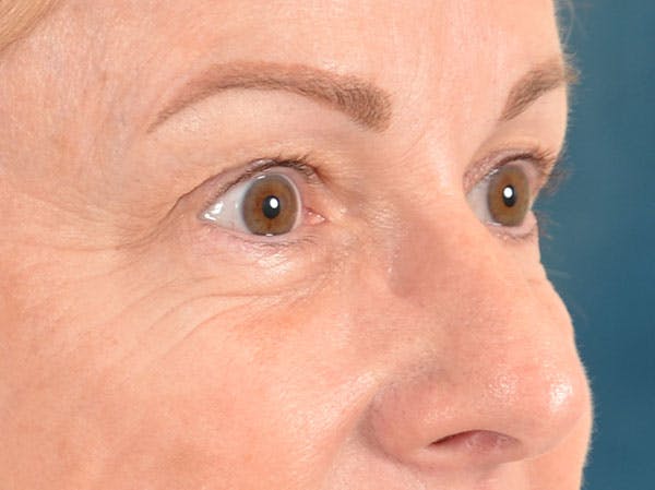 Eyelid Lift Before & After Gallery - Patient 158443150 - Image 7