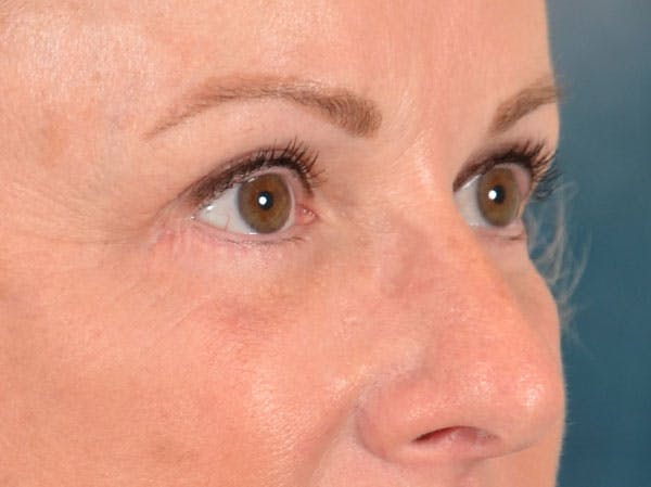 Eyelid Lift Before & After Gallery - Patient 158443150 - Image 8