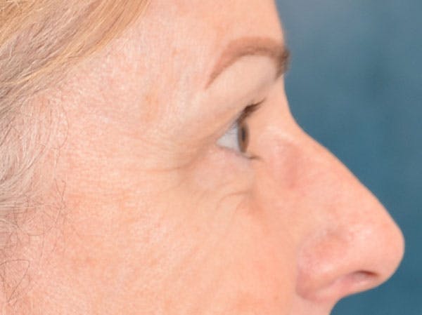 Eyelid Lift Before & After Gallery - Patient 158443150 - Image 9