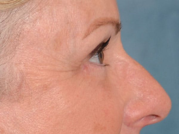 Eyelid Lift Before & After Gallery - Patient 158443150 - Image 10