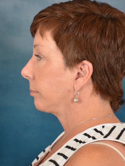 Brow Lift Before & After Gallery - Patient 158443164 - Image 6