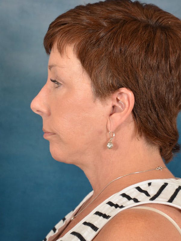 Deep Plane Facelift Before & After Gallery - Patient 169365968 - Image 6