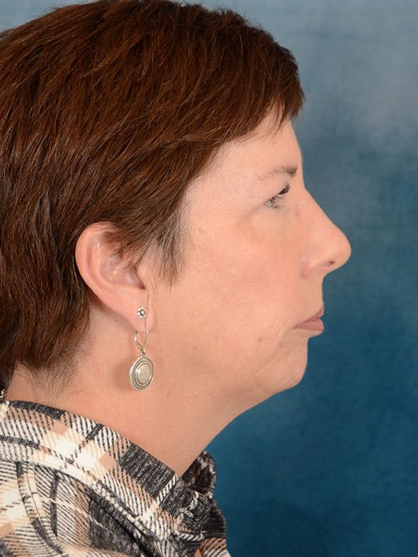 Deep Plane Facelift Before & After Gallery - Patient 169365968 - Image 9