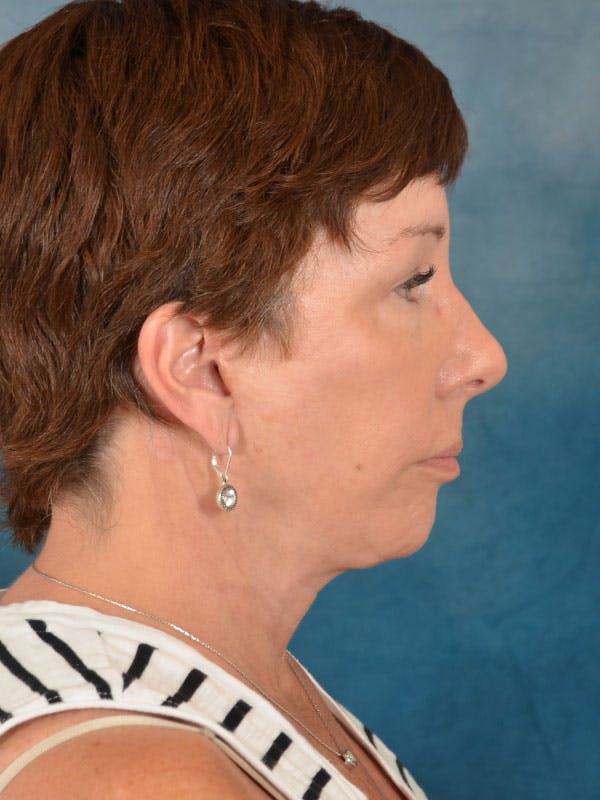 Deep Plane Facelift Before & After Gallery - Patient 169365968 - Image 10