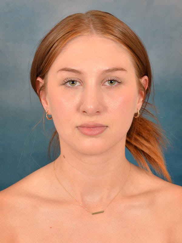 Rhinoplasty Before & After Gallery - Patient 158443192 - Image 4
