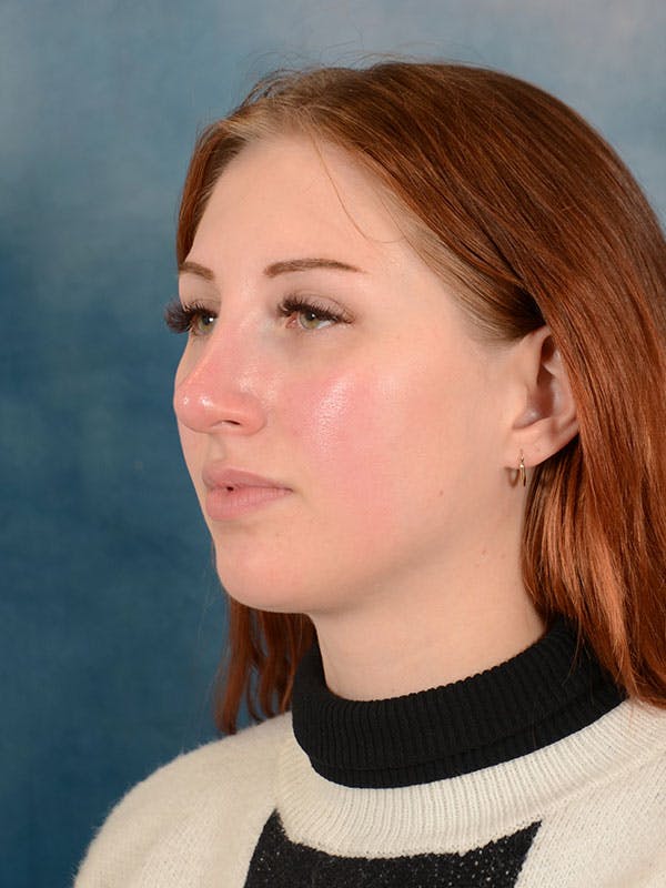 Rhinoplasty Before & After Gallery - Patient 158443192 - Image 5