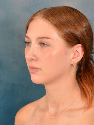 Rhinoplasty Before & After Gallery - Patient 158443192 - Image 6