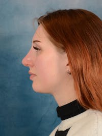 Rhinoplasty Before & After Gallery - Patient 158443192 - Image 1