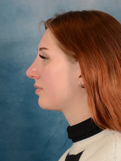 Rhinoplasty Before & After Gallery - Patient 158443192 - Image 1