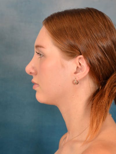 Rhinoplasty Before & After Gallery - Patient 158443192 - Image 2