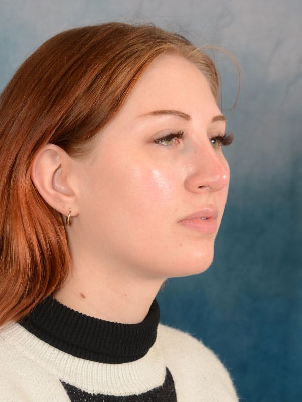 Rhinoplasty Before & After Gallery - Patient 158443192 - Image 7