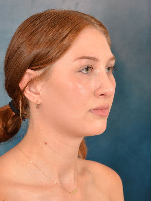 Rhinoplasty Before & After Gallery - Patient 158443192 - Image 8