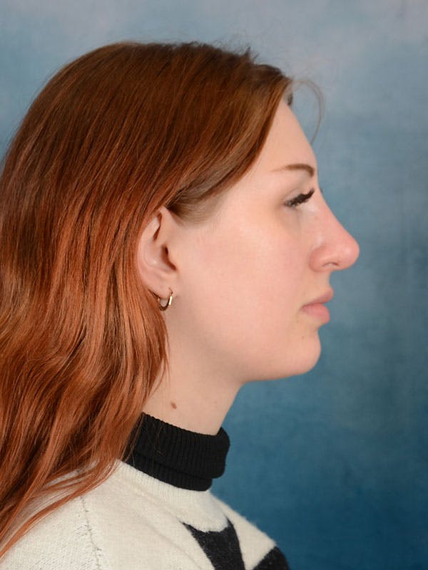 Rhinoplasty Before & After Gallery - Patient 158443192 - Image 9