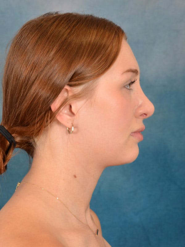 Rhinoplasty Before & After Gallery - Patient 158443192 - Image 10