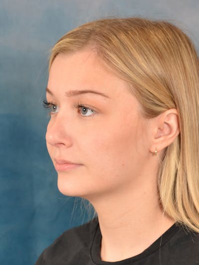 Rhinoplasty Before & After Gallery - Patient 169365954 - Image 6