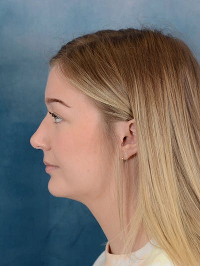 Rhinoplasty Before & After Gallery - Patient 169365954 - Image 1