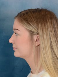 Rhinoplasty Before & After Gallery - Patient 169365954 - Image 1
