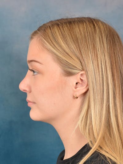 Rhinoplasty Before & After Gallery - Patient 169365954 - Image 2