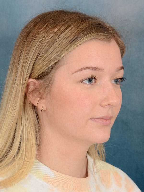 Rhinoplasty Before & After Gallery - Patient 169365954 - Image 7