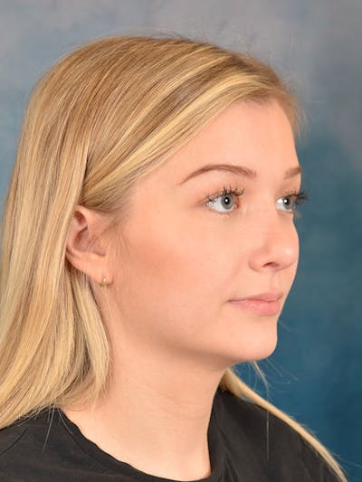 Rhinoplasty Before & After Gallery - Patient 169365954 - Image 8