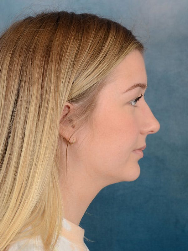 Rhinoplasty Before & After Gallery - Patient 169365954 - Image 9