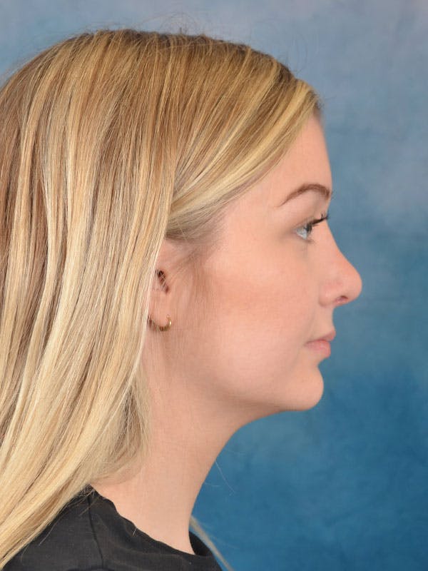 Rhinoplasty Before & After Gallery - Patient 169365954 - Image 10