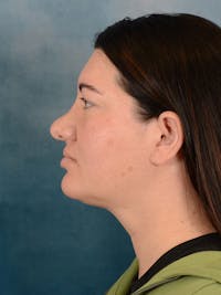 Revision Rhinoplasty Before & After Gallery - Patient 158444758 - Image 1