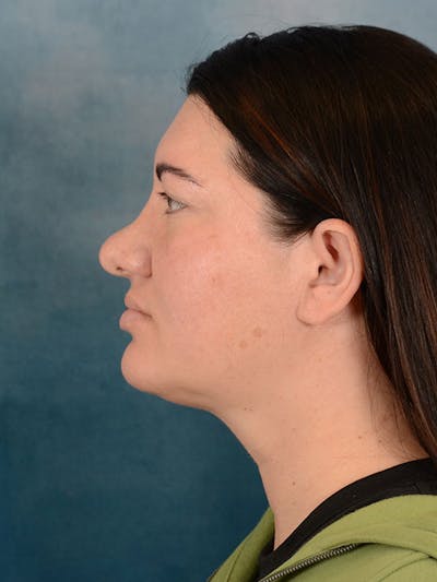 Revision Rhinoplasty Before & After Gallery - Patient 158444758 - Image 1