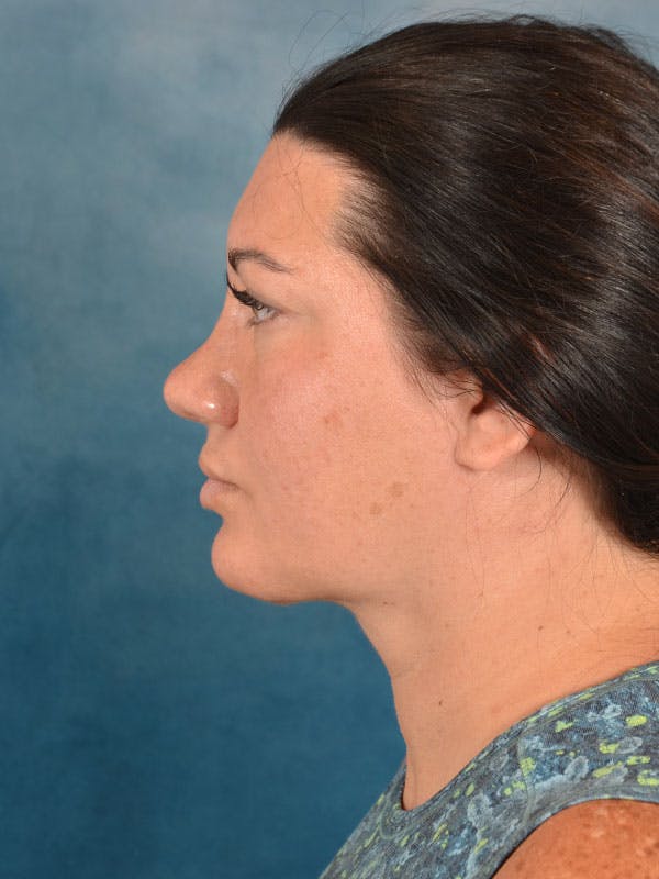 Deep Neck Lift Before & After Gallery - Patient 176432428 - Image 6