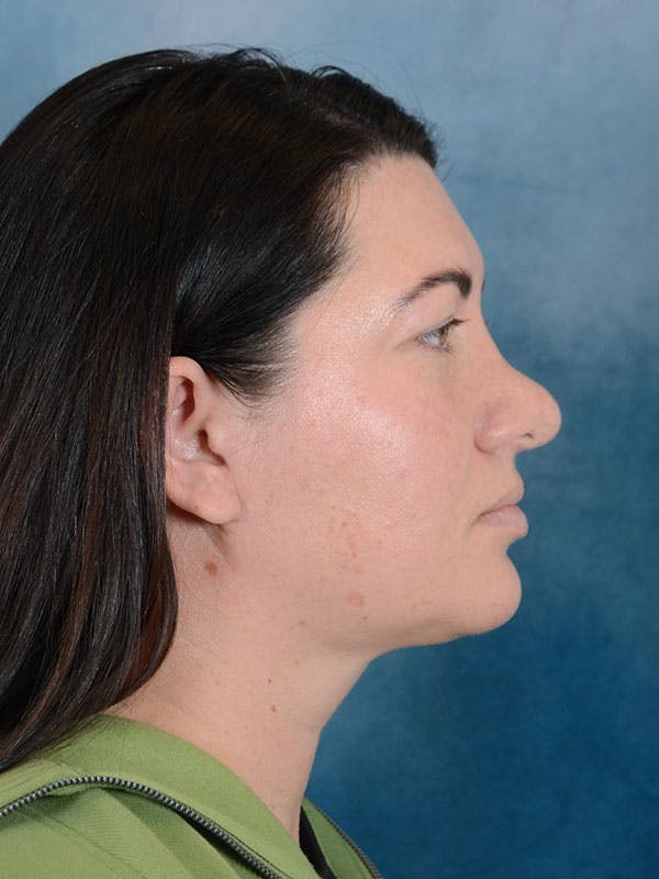 Revision Rhinoplasty Before & After Gallery - Patient 158444758 - Image 9
