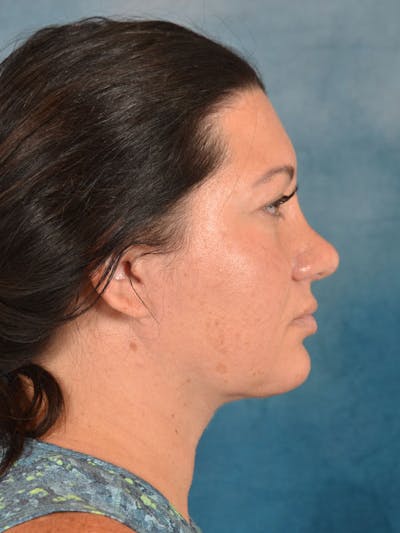 Deep Neck Lift Before & After Gallery - Patient 176432428 - Image 10