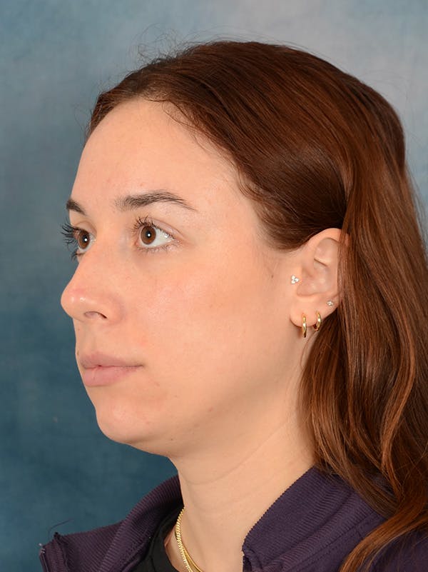 Rhinoplasty Before & After Gallery - Patient 169365959 - Image 3