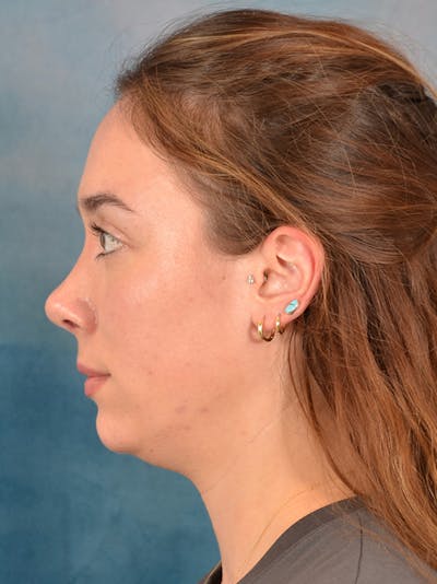 Rhinoplasty Before & After Gallery - Patient 169365959 - Image 2