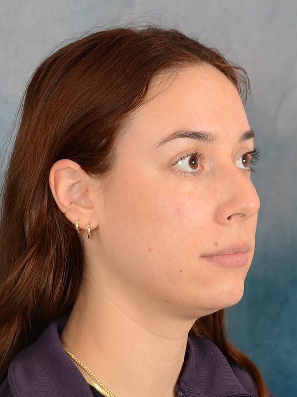 Rhinoplasty Before & After Gallery - Patient 169365959 - Image 7