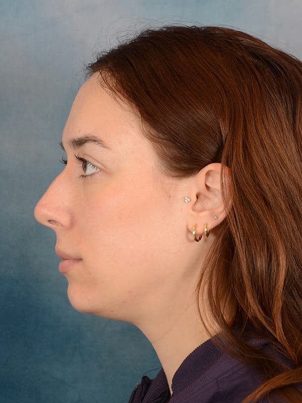 Rhinoplasty Before & After Gallery - Patient 169365959 - Image 1
