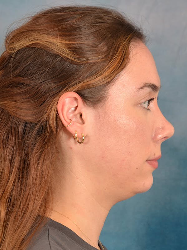Rhinoplasty Before & After Gallery - Patient 169365959 - Image 10