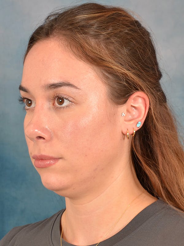 Rhinoplasty Before & After Gallery - Patient 169365959 - Image 4