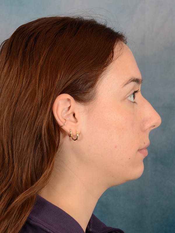 Rhinoplasty Before & After Gallery - Patient 169365959 - Image 9