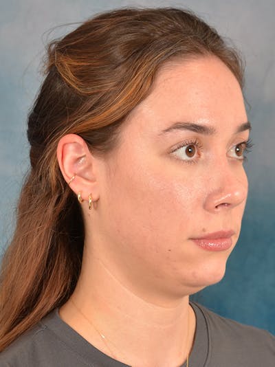 Rhinoplasty Before & After Gallery - Patient 169365959 - Image 8