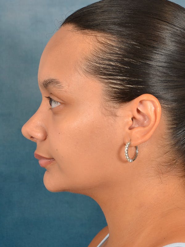 Rhinoplasty Before & After Gallery - Patient 169366042 - Image 2