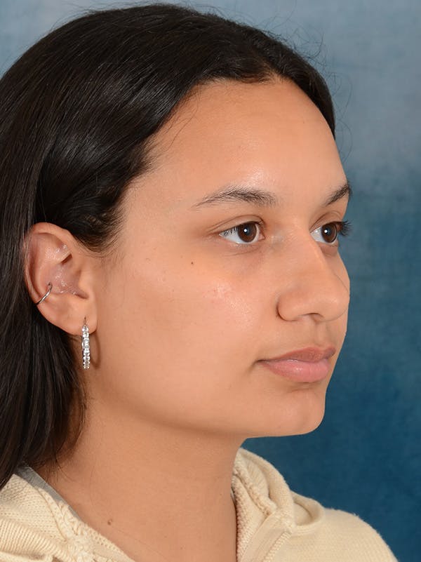 Rhinoplasty Before & After Gallery - Patient 169366042 - Image 7