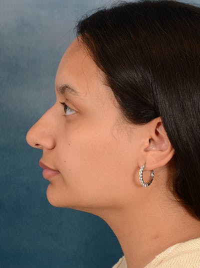 Rhinoplasty Before & After Gallery - Patient 169366042 - Image 1